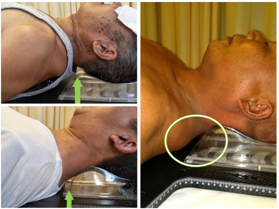 头部摆位,头部放疗,塑形垫,头枕